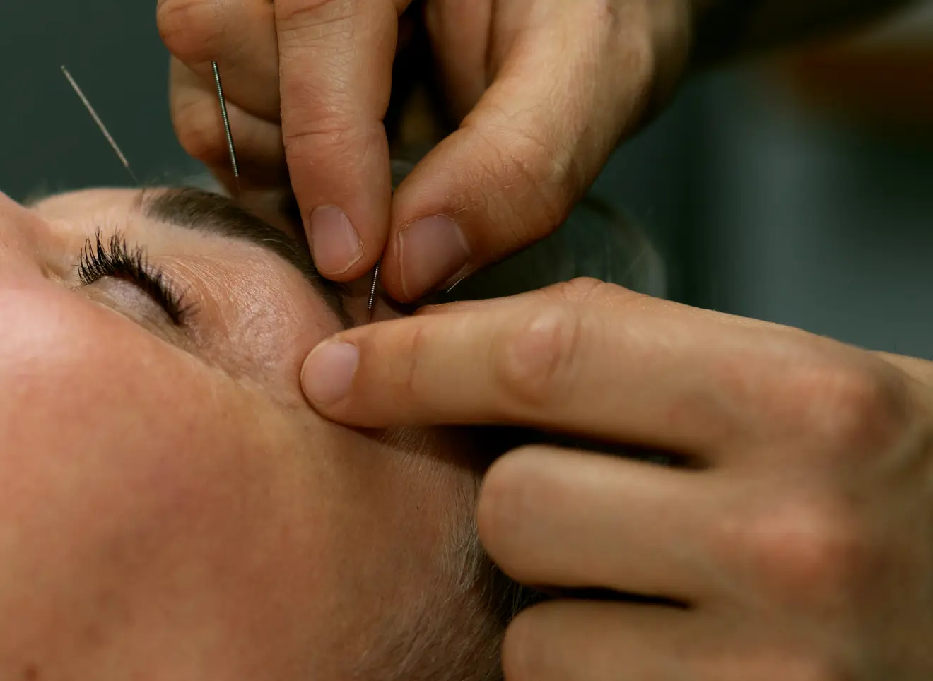 acupuntura (1)